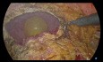 Résection antérieure laparoscopique avec un bloc de résection partielle de la vessie urinaire