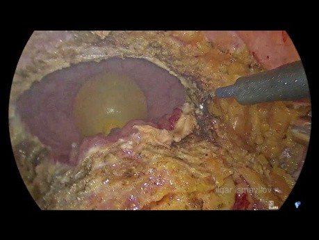 Résection antérieure laparoscopique avec un bloc de résection partielle de la vessie urinaire