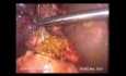 Cholédochoduodénostomie par voie laparoscopique