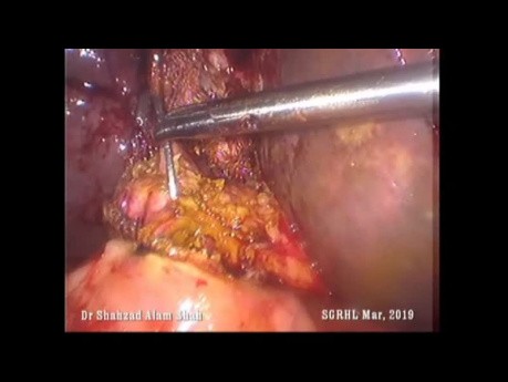 Cholédochoduodénostomie par voie laparoscopique