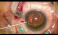 Subluxation de LIO monobloc - Capture optique de capsulorhexis antérieur