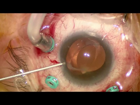 Subluxation de LIO monobloc - Capture optique de capsulorhexis antérieur