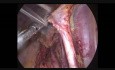Lymphadénectomie pelvienne laparoscopique lors de lHystérectomie de Werthems