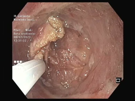 Résection d'Adénome Gastrique