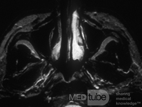 Le cycle nasal normal