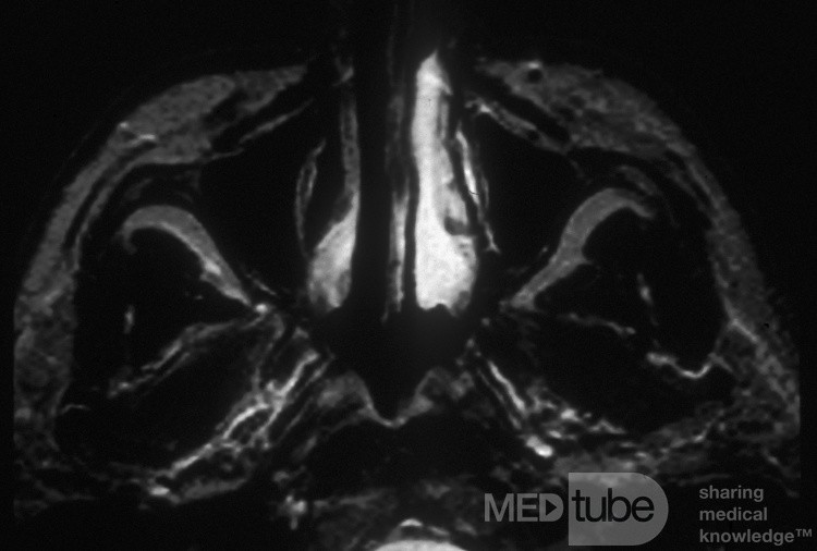 Le cycle nasal normal