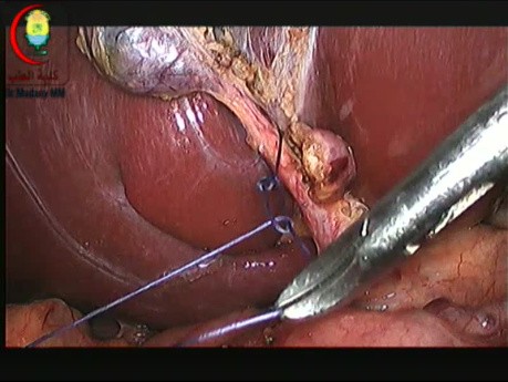 Contrôle du Canal Cystique avec Ablation de Sutures