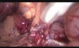 Hémicolectomie gauche assistée par laparoscopie étendue à la paroi abdominale et au tissu adipeux périnéphrotique à cause du cancer du côlon descendant localement avancé 