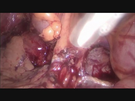 Hémicolectomie gauche assistée par laparoscopie étendue à la paroi abdominale et au tissu adipeux périnéphrotique à cause du cancer du côlon descendant localement avancé 