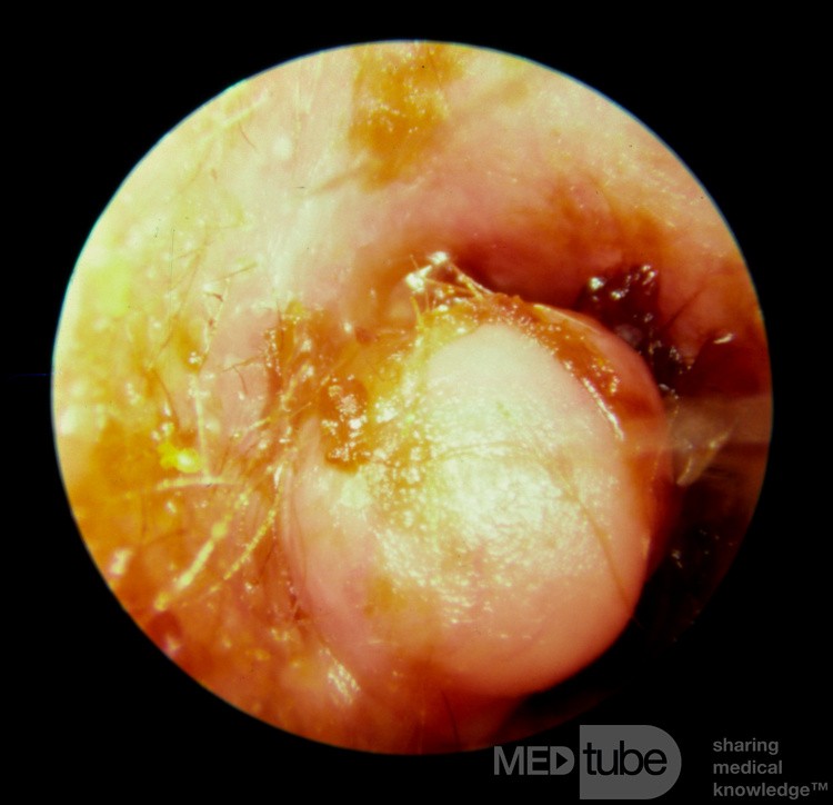 Ostéome bénin obturant le conduit auditif externe