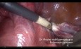 Hystérectomie avec adhérences vasculaires épiploïques