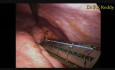 Ablation du kyste du conduit cholédoque avec hépato-jéjunostomie par voie laparoscopique