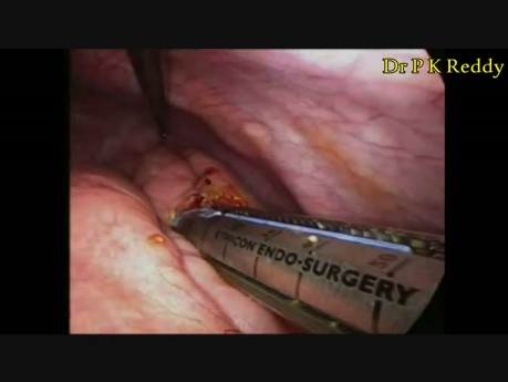 Ablation du kyste du conduit cholédoque avec hépato-jéjunostomie par voie laparoscopique