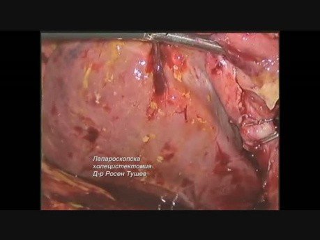 Cholécystectomie Coelioscopique