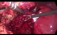 Cholécystectomie par laparoscopie pour une cholécystite. Gestion de saignement du lit vésiculaire