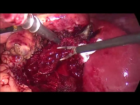 Cholécystectomie par laparoscopie pour une cholécystite. Gestion de saignement du lit vésiculaire