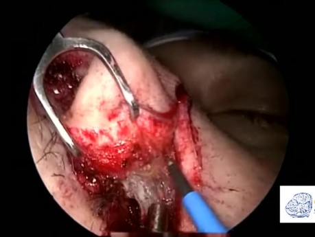 Chirurgie de Rhinotomie Latérale