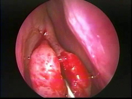 Résection de Concha Bullosa