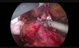 Conversion en une Seule Etape d'un Anneau Gastrique Echoué en une Gastrectomie Sleeve
