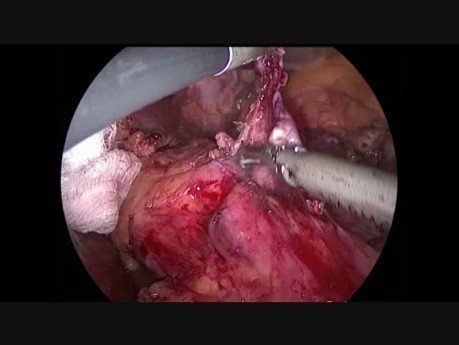 Conversion en une Seule Etape d'un Anneau Gastrique Echoué en une Gastrectomie Sleeve