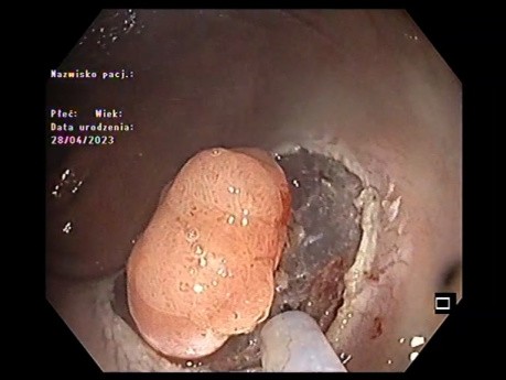 Petite Tumeur Rectale, Dissection Sous-Muqueuse Endoscopique Sans Complications