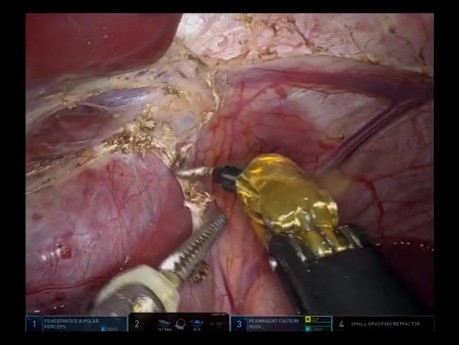 Hépatectomie Gauche Robotisée et Résection Partielle du Lobe Carré 