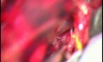 Clipping d'un anévrisme de l'artère basilaire