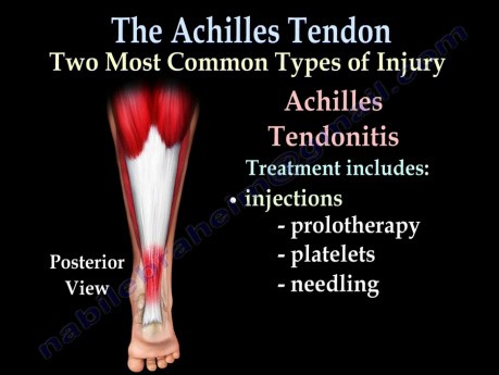 Rupture du tendon d'Achille