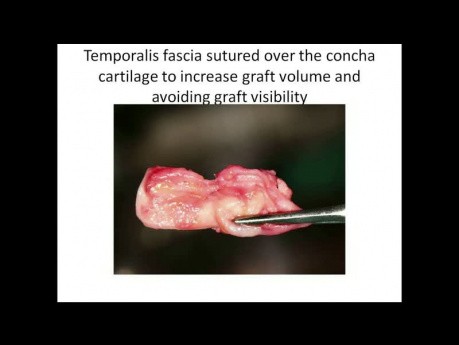 Nez Tombant - Technique de Correction avec Greffe de Cartilage de la Conque