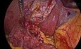 Cholécystectomie Rétrograde