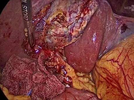 Cholécystectomie Rétrograde