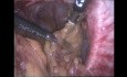 Traitement cœlioscopique de la hernie parastomiale selon technique de Sugarbaker