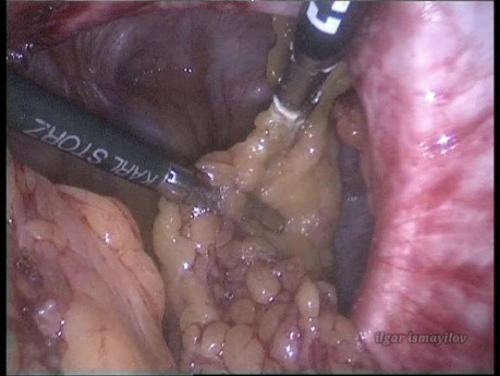 Traitement cœlioscopique de la hernie parastomiale selon technique de Sugarbaker