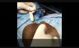 Réparation du sphincter anal - sphincteroplastie