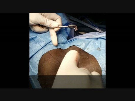 Réparation du sphincter anal - sphincteroplastie