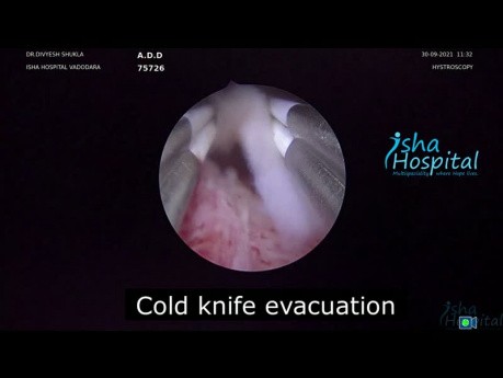 Hystéroscopie au couteau froid: Évacuation de cicatrice de grossesse extra-utérine de type 1