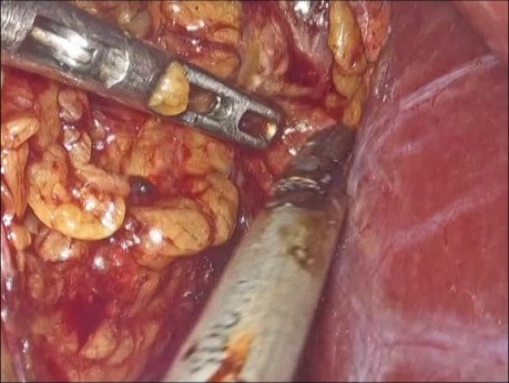 Surrénalectomie droite par voie laparoscopique