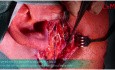 Ostéosynthèse de Fracture de la Base du Condyle Mandibulaire