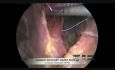 Fundoplicature de Nissen pour reflux gastro-oesophagien (RGO)