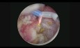 TURBT Monobloc
