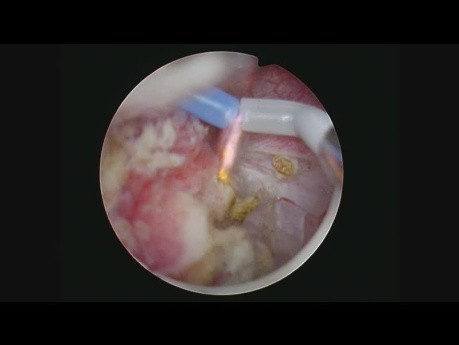 TURBT Monobloc
