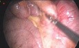 Douleur Persistante Post-Appendicectomie et Anatomie Pathologique
