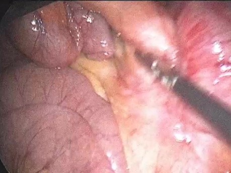Douleur Persistante Post-Appendicectomie et Anatomie Pathologique