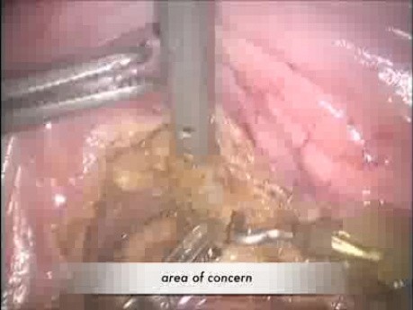 Avantage de l'excision mésorectale totale robotisée dans le cancer rectal avancé