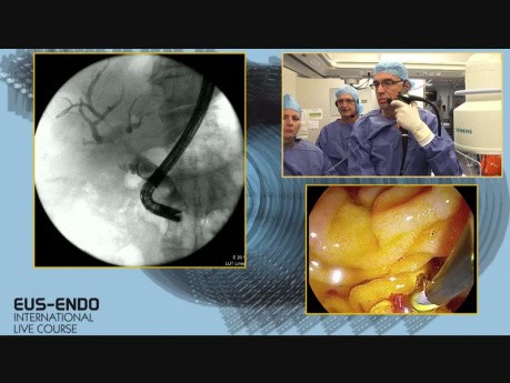 L'échographie endoscopique suivi de la CPRE