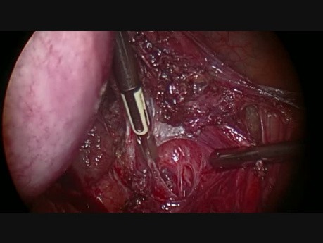 Indication de l'ICG - Carcinome Epidermoïde Cervical G2