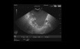 Écho-endoscopie d'une nécrose pancréatique circonscrite (Walled-off necrosis - WON)