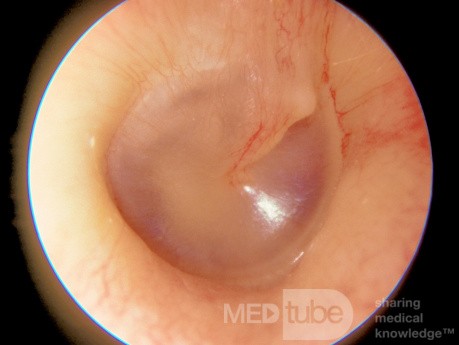 Membrane tympanique droite normale