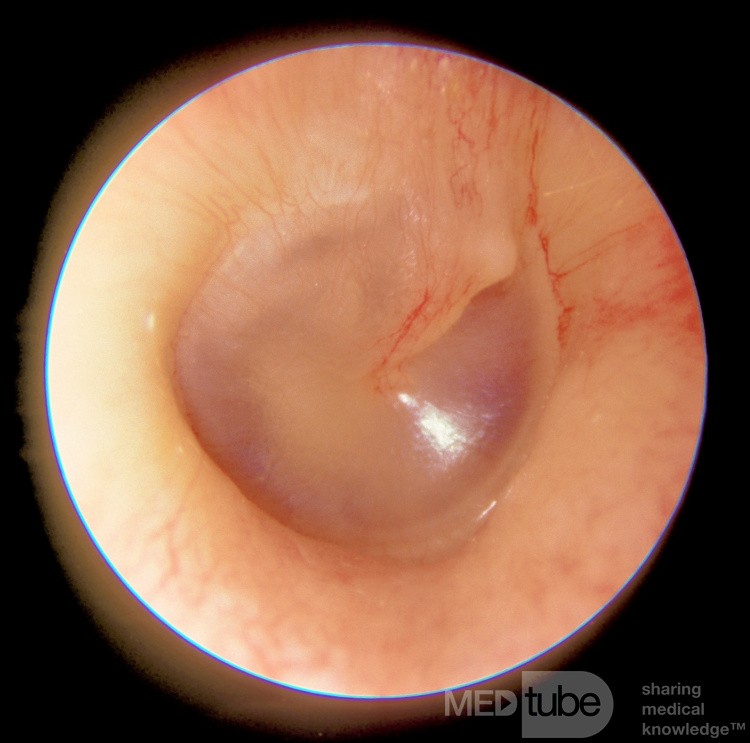 Membrane tympanique droite normale