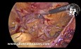 Technique Transabdominale Laparoscopique pour la Réparation de la Hernie Inguinale (TAPP)
